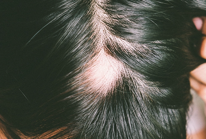 Clínica Verussa - Alopecia Areata