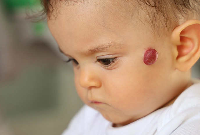 Clínica Verussa - Hemangioma