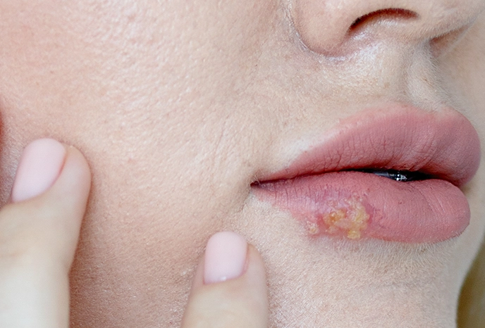 Clínica Verussa - Herpes Simples